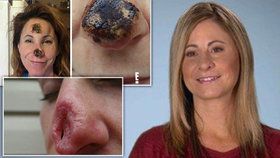 Homeopatika ženě »rozpustila« nos! Lékaři jí museli udělat úplně nový