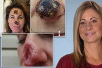 Homeopatika ženě »rozpustila« nos! Lékaři jí museli udělat úplně nový