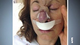Ženě se rozpustil nos. Po zpackané operaci jí museli udělat nový od základu.