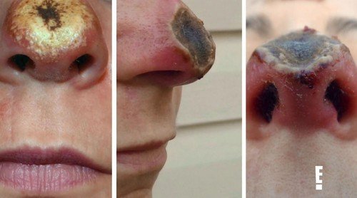 Ženě se rozpustil nos. Po zpackané operaci jí museli udělat nový od základu.
