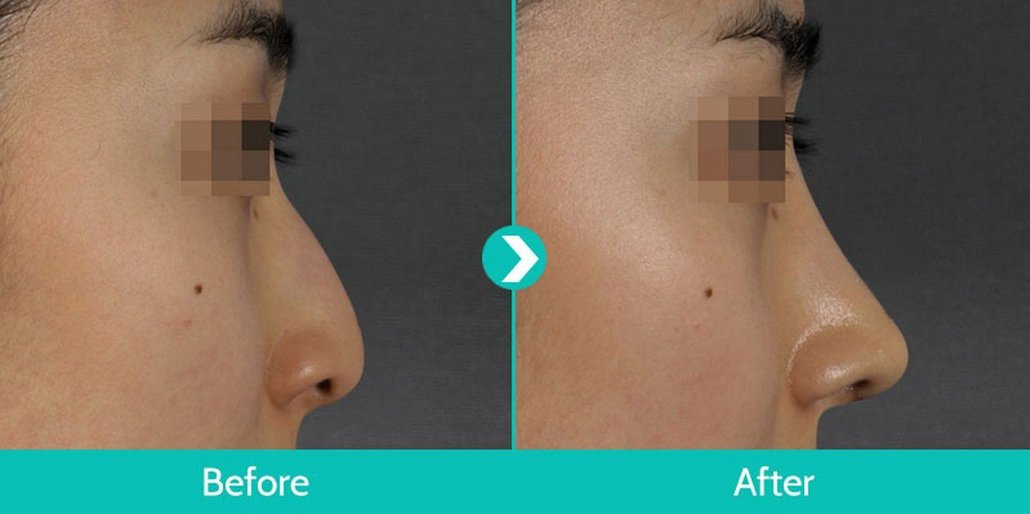 Jak zmenit tvar nosu bez operace?