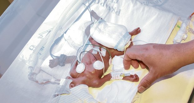 Novorozeně v inkubátoru v Pachuce