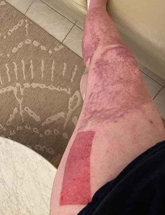 Přeživší výbuchu sopky Stephanie Browittová na sociálních sítích sdílí svou léčbu. Tahle vypadá její stehno po odběru kožního štěpu.