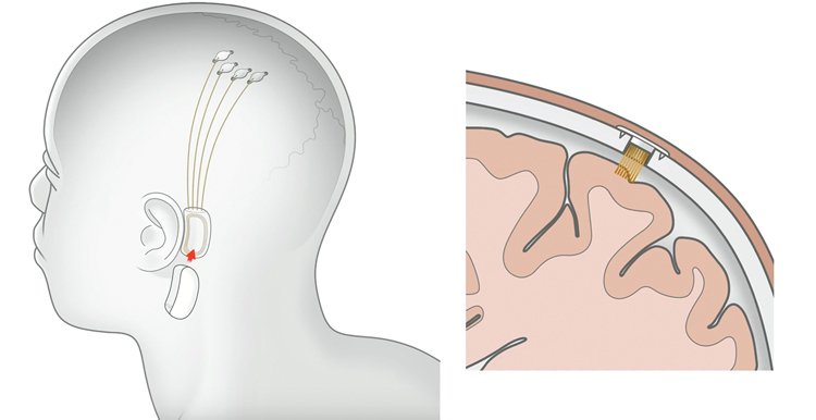 Čip Neuralink v hlavě snímá elektrické signály mozku