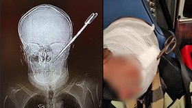 Žena po hádce muži zabodla nůžky do hlavy. (1. března 2022)