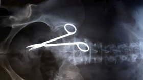 11 bizarních rentgenových snímků s předměty, které lékaři našli v lidském těle