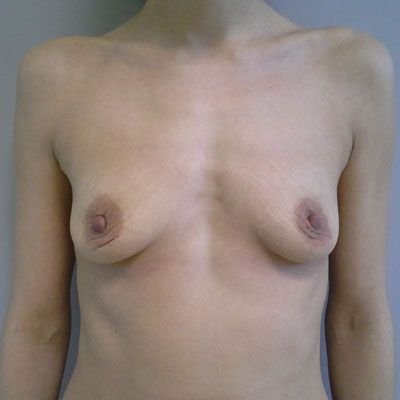 Před zvětšením prsou prsními implantáty.
