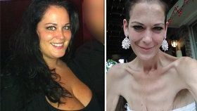 Obézní matce čtyř dětí zpackali operaci žaludku: Zhubla na 38 kilo a bojovala o život