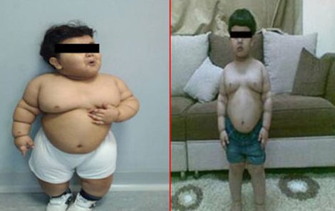 Před operací chlapeček vážil 33 kg. Později "jen" 24 kg.