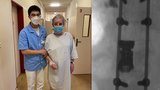 Unikátní zákrok ve Znojmě: Muži, který uklouzl v koupelně, operovali obratel přes hrudník