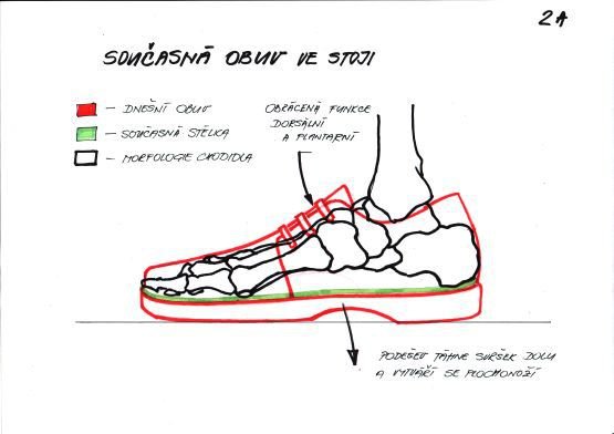 Srovnání polohy chodidla v běžné obuvi a obuvi navržené Josefem Hanákem. Jeho výrobek umožňuje, aby vznikla podélná a příční klenba, která umožní v botě přirozený pohyb, jako by šel člověk naboso.
