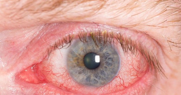 Spaní v kontaktních čočkách: 6x vyšší riziko infekce oka
