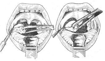 Po vypreparování až k dolnímu pólu se stopka mandle oddělí od kořene jazyka a mandle se odstraní. Velmi pečlivě se staví krvácení tampony nebo elektrokoagulační pinzetou.