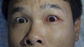 Muži z Číny vypadlo při opilosti oko z důlku. Rodina ho našla v kaluži krve (ilustrační foto)