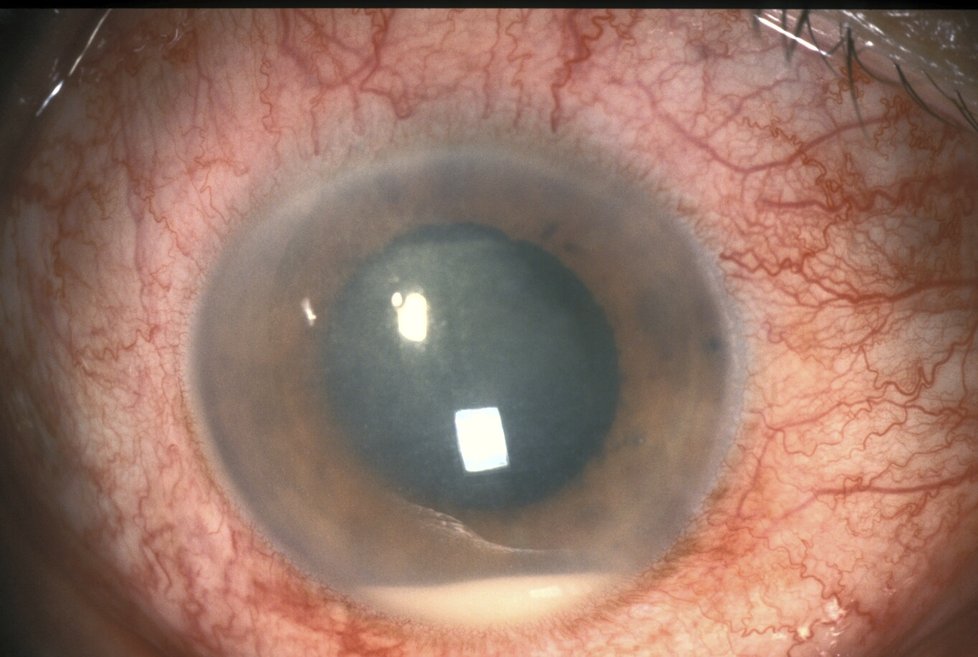 Oko postižené uveitidou