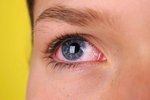 Na zarudlé oči někdy pomohou kapky, pokud je příčinou nemoc, může být potřeba i operace.
