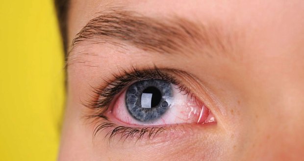 Na zarudlé oči někdy pomohou kapky, pokud je příčinou nemoc, může být potřeba i operace.