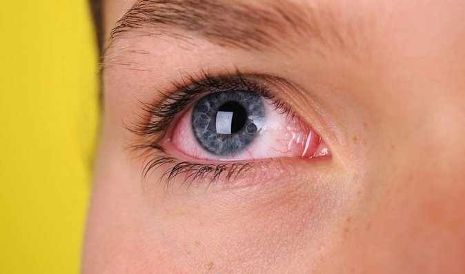 Jak ulevit očím v období alergie? Pomohou kapky i obyčejné brýle