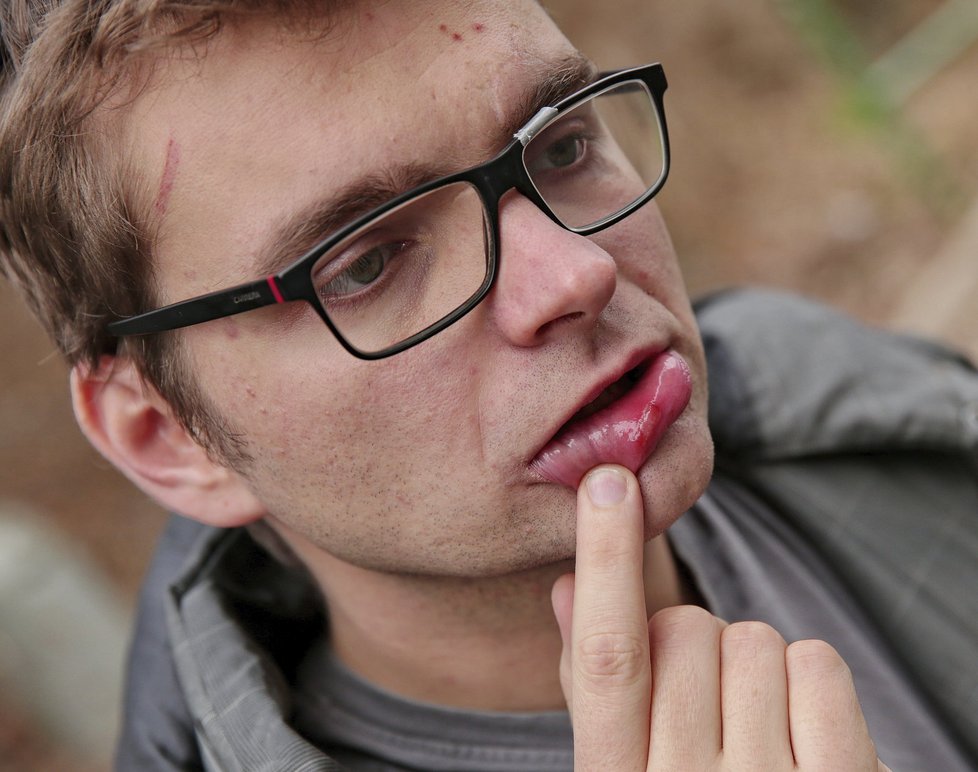 Fotograf Jiří Schott ukazuje rozseknutý ret, šrám na čele a rozbité brýle.