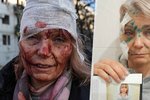 Žena, jejíž tvář se stala symbolem začátku války, přežila! Teď  Olenu čeká operace oka
