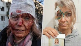 Její poraněná tvář se stala symbolem začátku války: Učitelka Olena přežila! 