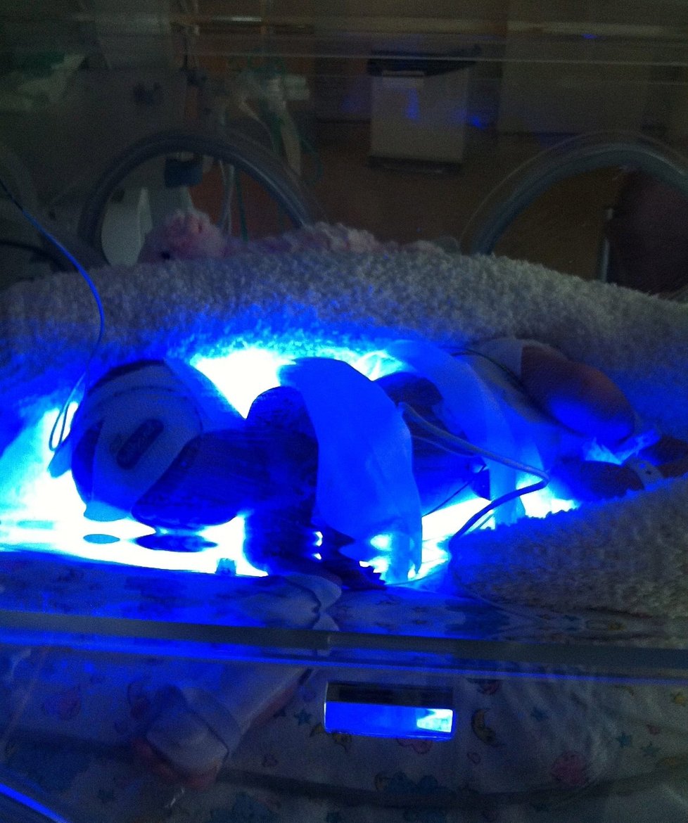 Kvůli novorozenecké žloutence podstoupila malá Olivia fototerapii modrým světlem