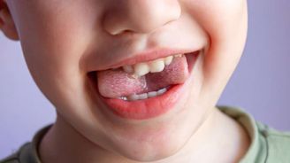 Bílé skvrny na zubech u dětí nepodceňujte. Upozorňují na tento problém Bílé skvrny na zubech u dětí nepodceňujte. Upozorňují na tento problém