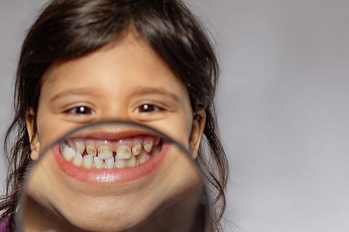 Co prozradí zuby o zdraví dítěte? Zaměřte se na tohle Co prozradí zuby o zdraví dítěte? Zaměřte se na tohle