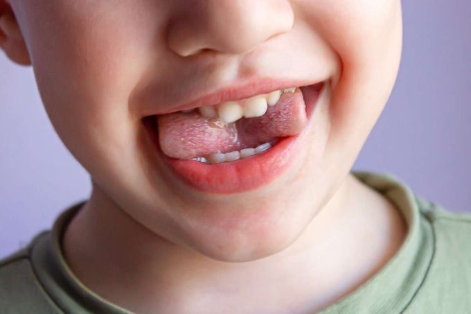 Bílé skvrny na zubech u dětí nepodceňujte. Upozorňují na tento problém Bílé skvrny na zubech u dětí nepodceňujte. Upozorňují na tento problém