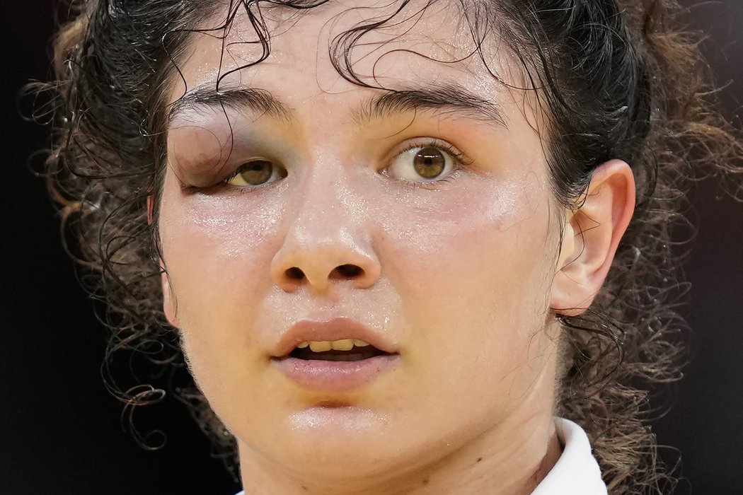 Ruská judistka Madinoa Tajmazovová dokráčela k bronzu v kategorii do 70 kg s vážně zraněným okem