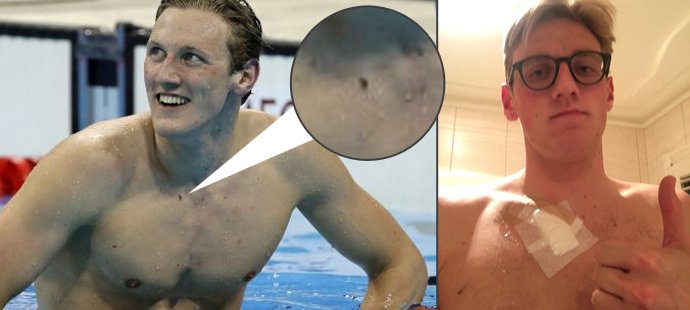 Australský plavec Mack Horton vyhrál v Riu s divnou pihou na těle. Fanoušek mu našel rakovinu.
