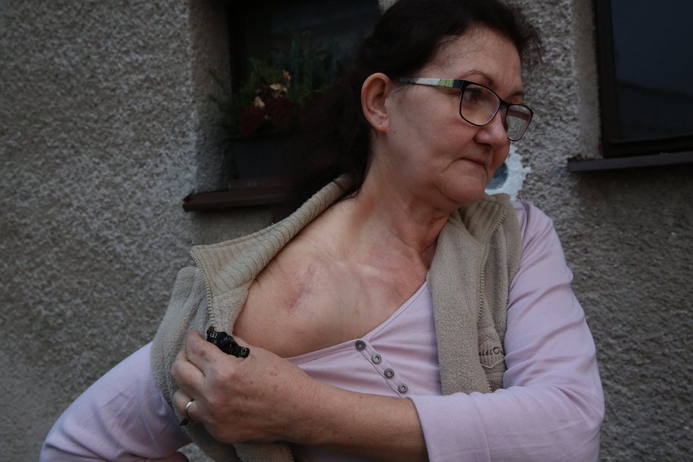 Po operaci ramene zůstala paní Mileně nepěkná jizva.