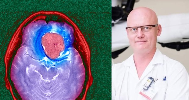 Blesk hovořil s předním onkologem Jakubec Cvekem o nádorech mozku.