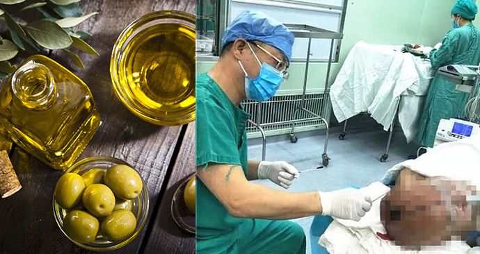 Šedesátiletá žena připravila během operace mozku 90 plněných oliv