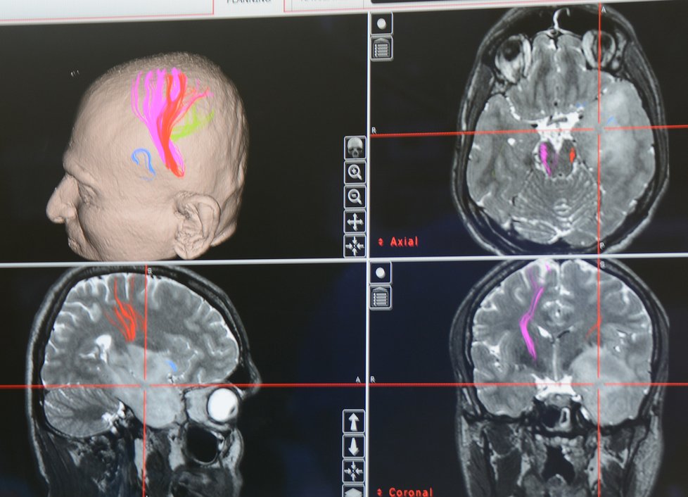 Jaroslav Koukol (36) z Jindřichohradecka si během operace nádoru na mozku s lékaři povídal.