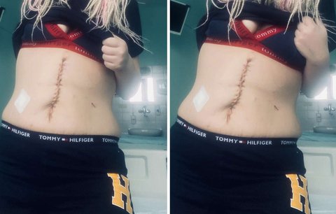 Vyrovnala se se svým tělem a nyní ho miluje. Moje jizvy mi zachránily život, říká
