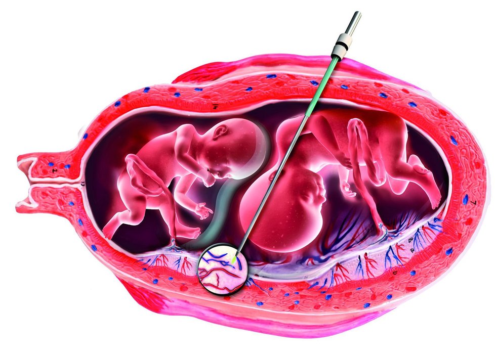 Lékař pomocí laseru vsunutého do dělohy oddělí cévy, které placentu propojují.