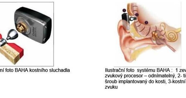 Systém BAHA. Sluchadlo se nacvakne na titanový šroub, který předtím lékaři voperovali pacientovi do lebeční kosti za ušní boltec.