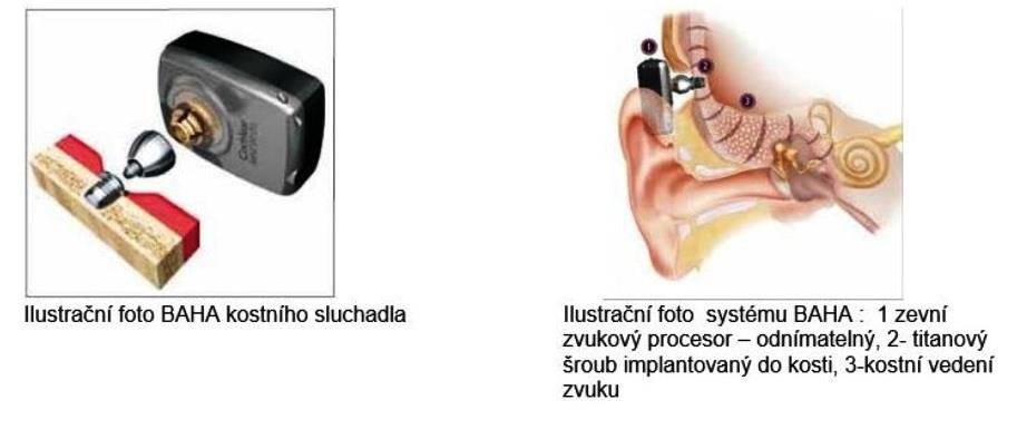 Systém BAHA. Sluchadlo se nacvakne na titanový šroub, který předtím lékaři voperovali pacientovi do lebeční kosti za ušní boltec.