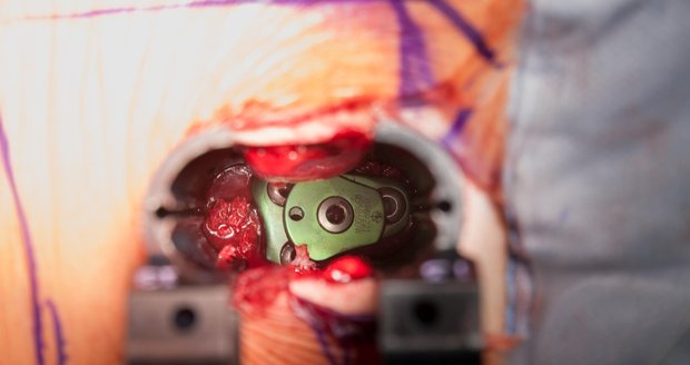 Pohled na implantáty, které mezi bederními obratli pacienta zajišťují speciální šrouby.