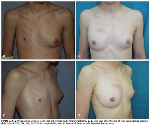Ilustrační fotografie - Pacientka, které bylo prso zrekonstruováno díky tuku obohacenému o kmenové buňky