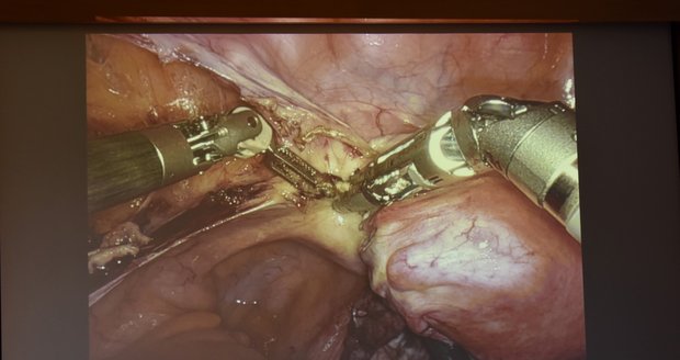 Robotické přerušení cév zásobujících dělohu pacientky z pohledu gynekologů.