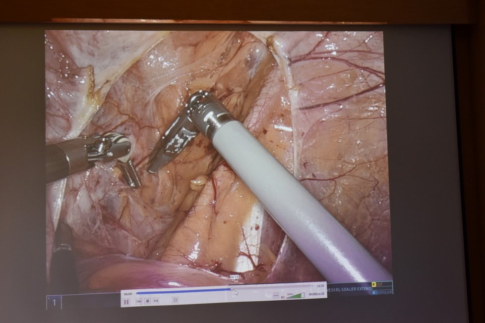 Robotické přerušení cév zásobujících dělohu pacientky z pohledu gynekologů.