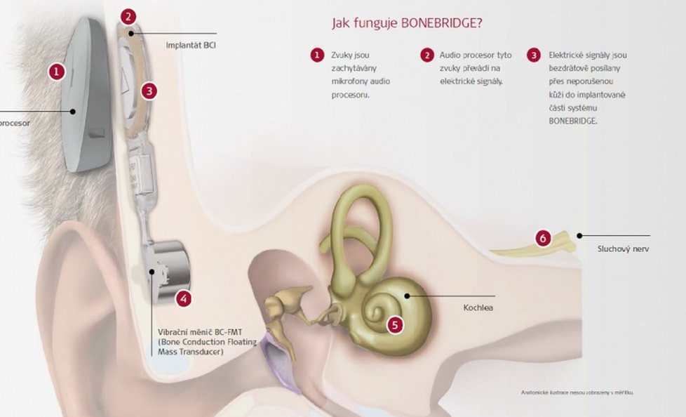 Schéma fungování ušního implantátu pro kostní vedení v hlavě dítěte.
