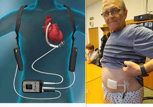 Jan Sadílek (64) z Brna, první pacient s implantovanou nejmodernější světovou srdeční podporou Heart Mate III v brněnské nemocnici.