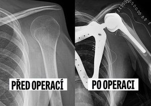 Rentgenový snímek před a po implantaci lopatky a ramenního kloubu. První operace svého druhu v ČR.