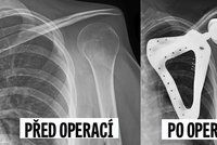 Unikátní zákrok: Studentovi po nádoru lékaři vytiskli a voperovali nové rameno