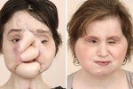 Tvář 21leté Katie před a po poslední operaci