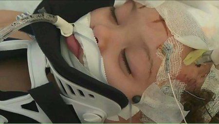 Dvouletá dívka musela podstoupit operaci mozku.