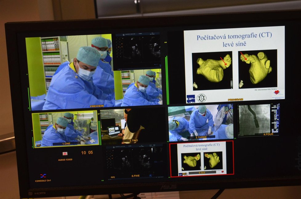 Průběh operace sledovali kolegové lékařů na monitorech v přímém přenosu z chirurgického sálu.